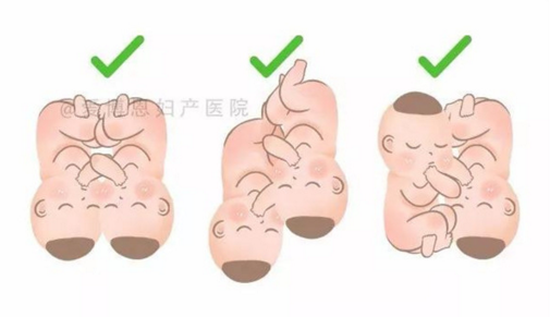 生雙胞胎一定要剖腹？記愛博恩雙胞胎妊娠媽媽的順產(chǎn)記錄